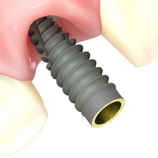 Tapered Pro Conical dental implant